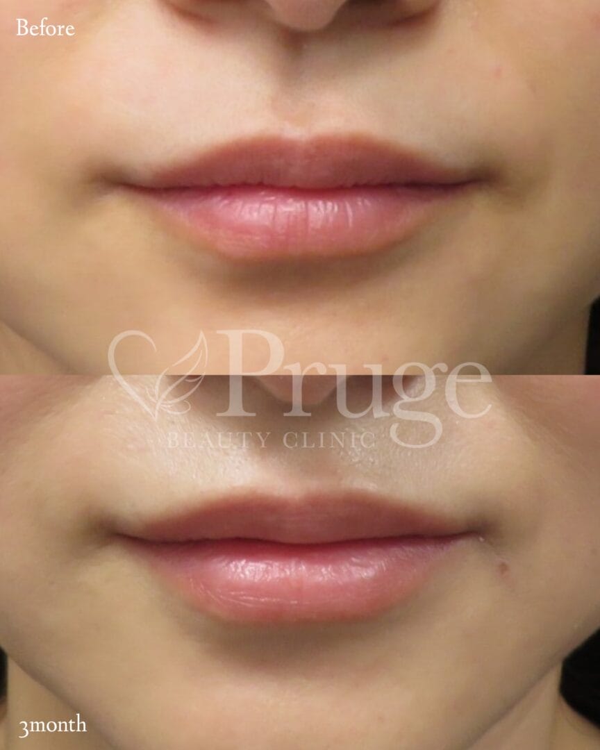 PRP注射（唇）の症例写真