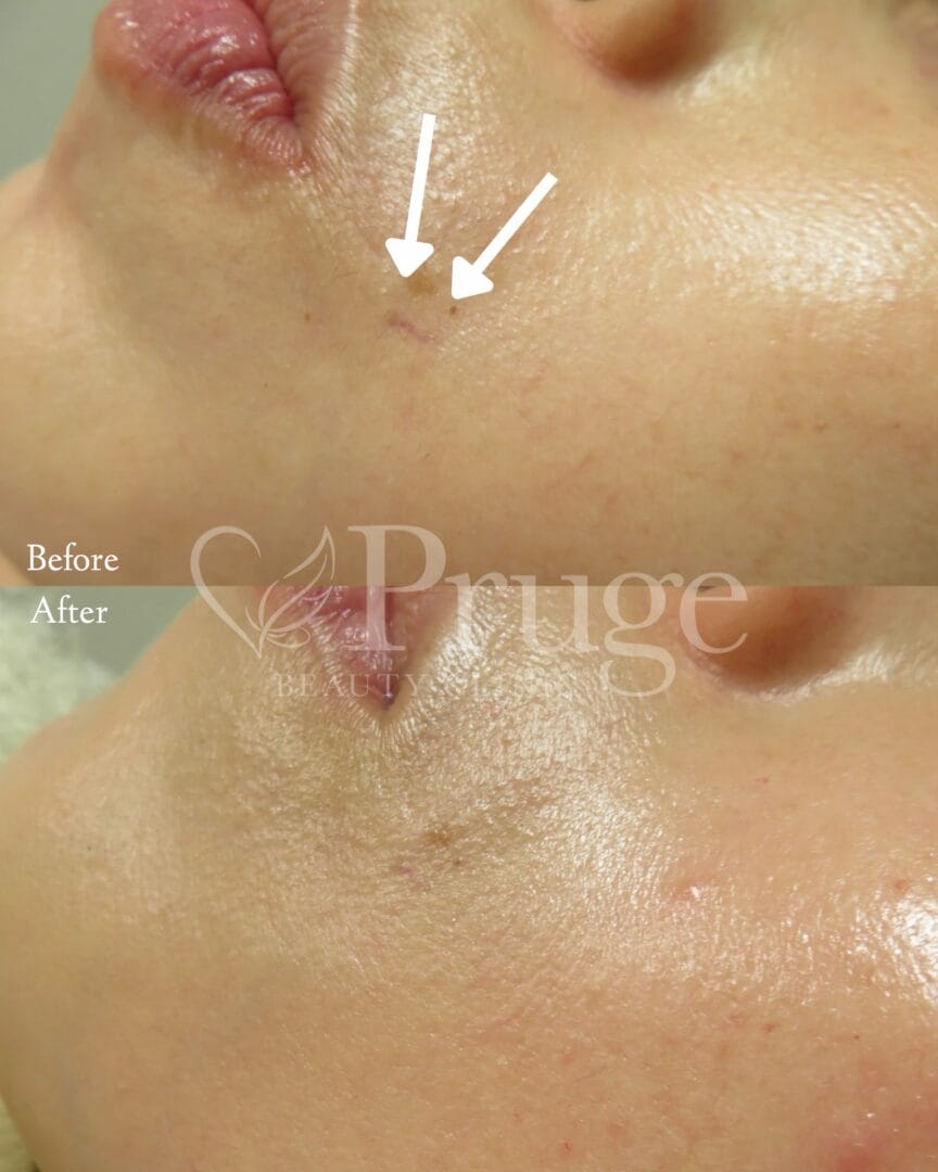 口横の血管に対するフェイススクレロセラピー