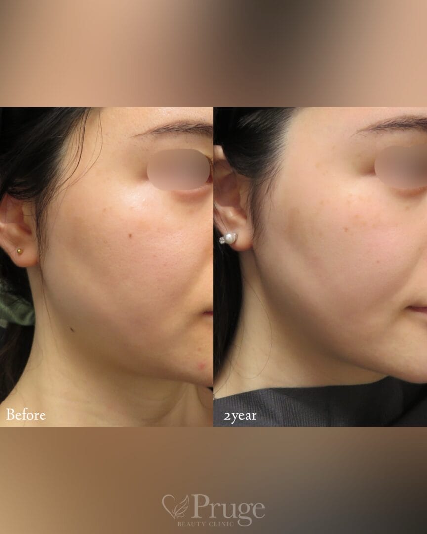 pスリム注射(フェイスライン)の症例写真