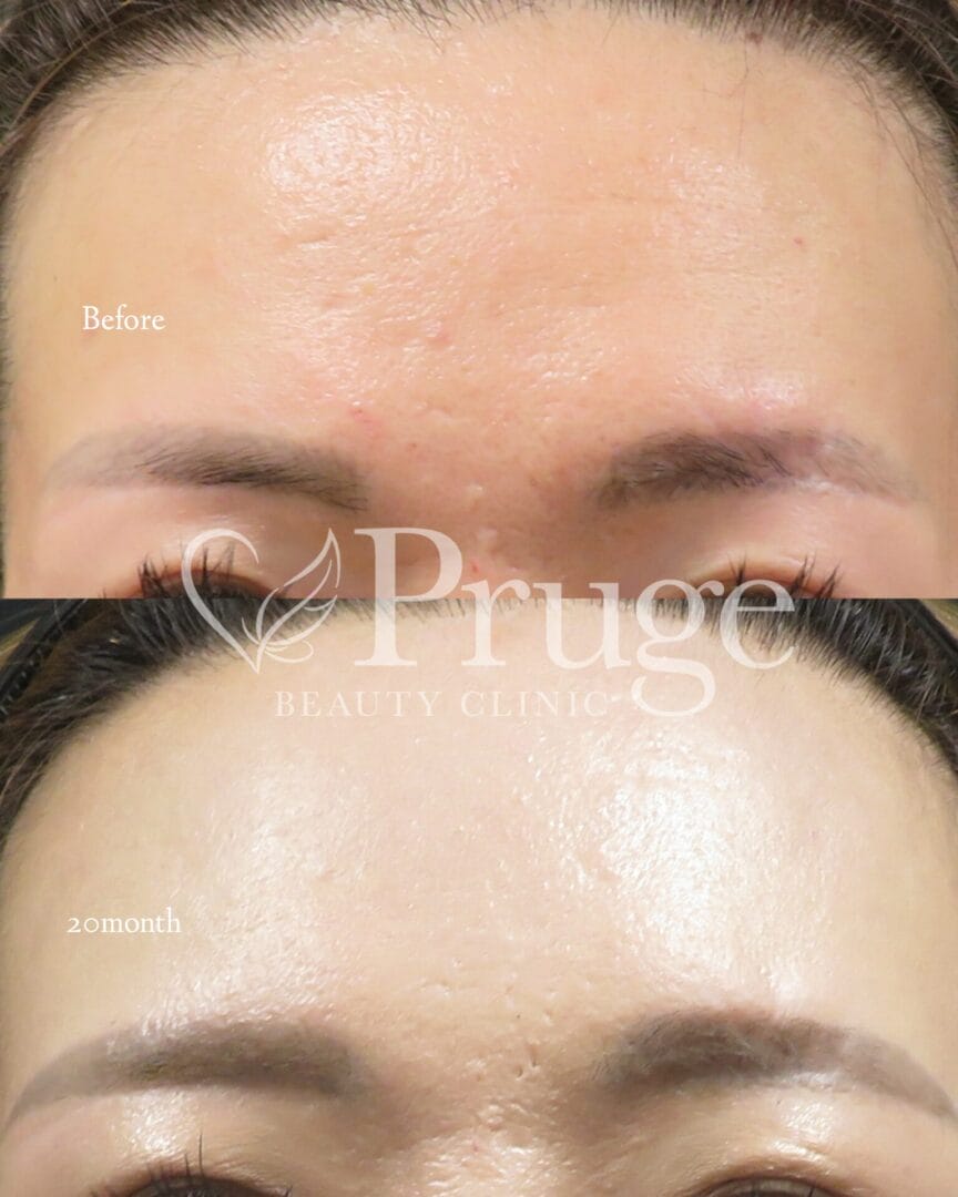 PRP注射(額のシワ)