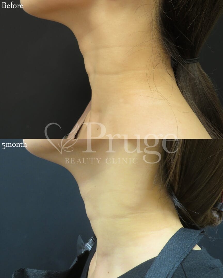 PRP注射(首)の症例写真