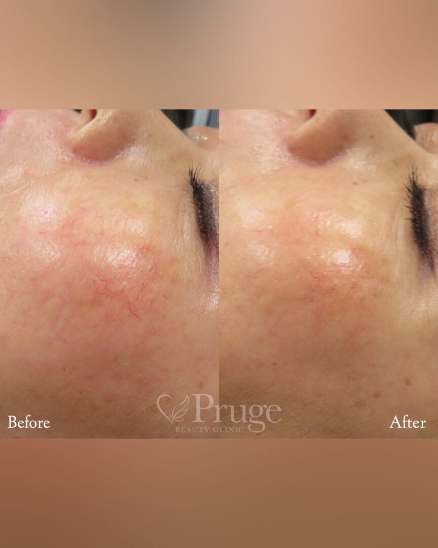 ホホの血管に対するフェイススクレロセラピー