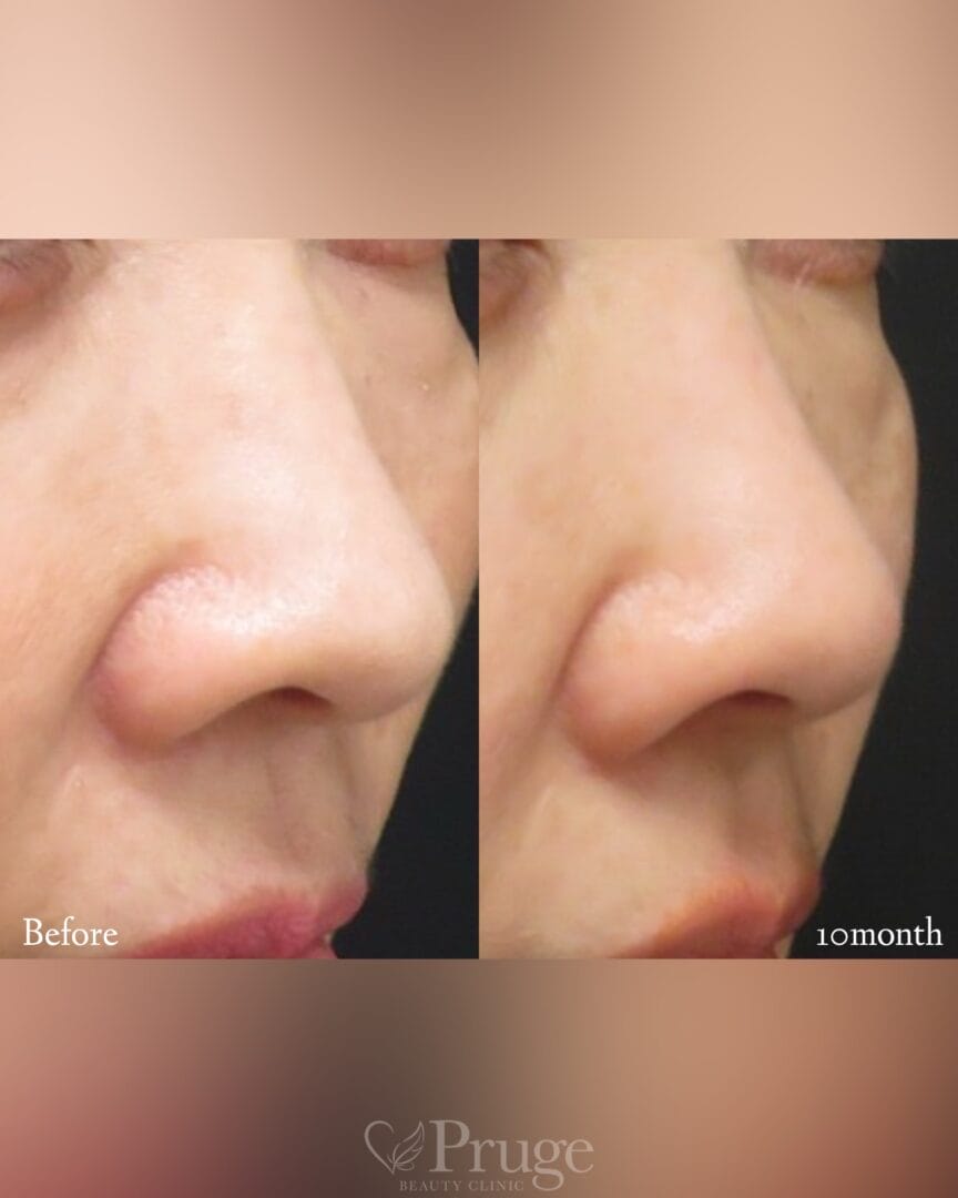 PRP注射(鼻孔縁)の症例写真