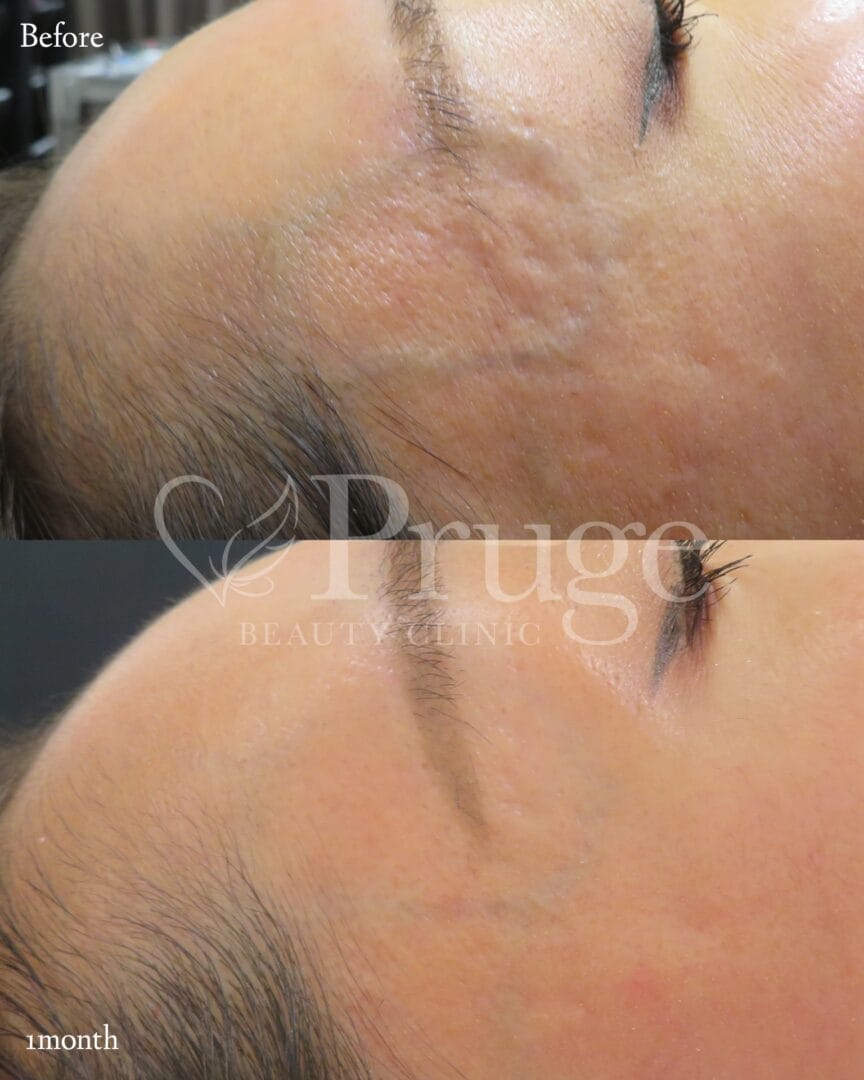 こめかみの血管に対するフェイススクレロセラピーの症例写真