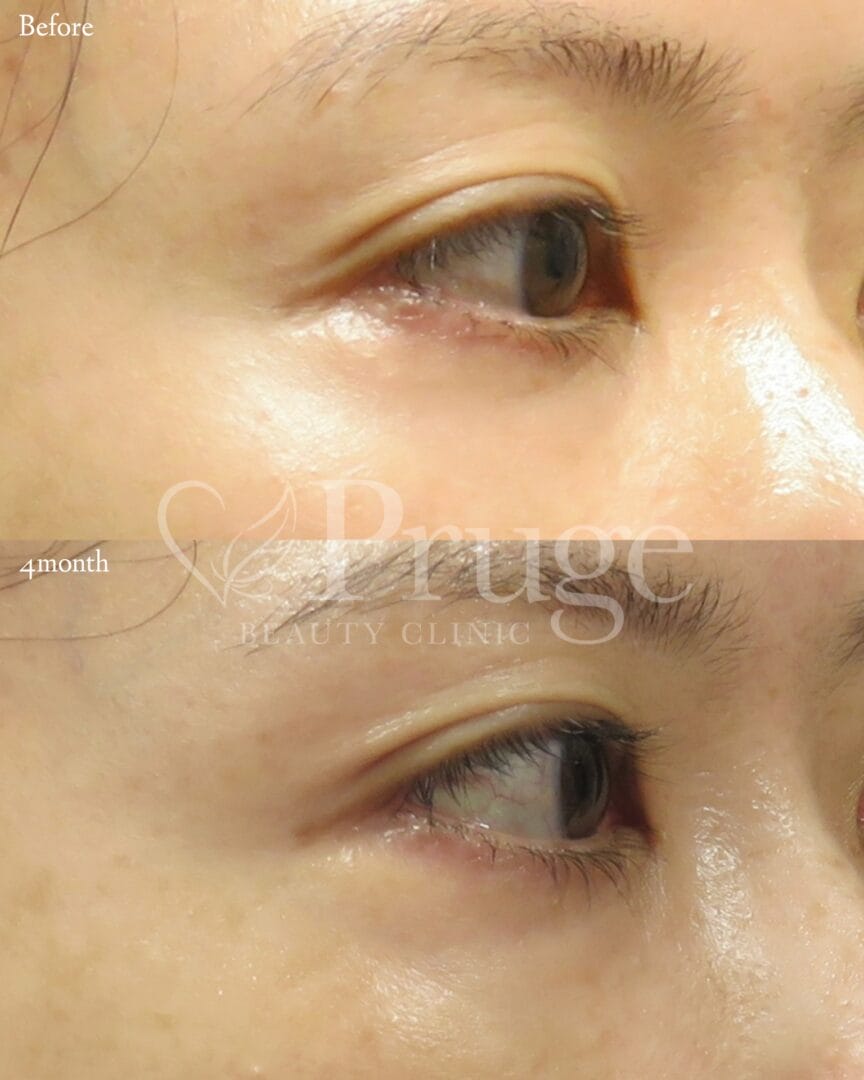 PRP注射(目尻)の症例写真