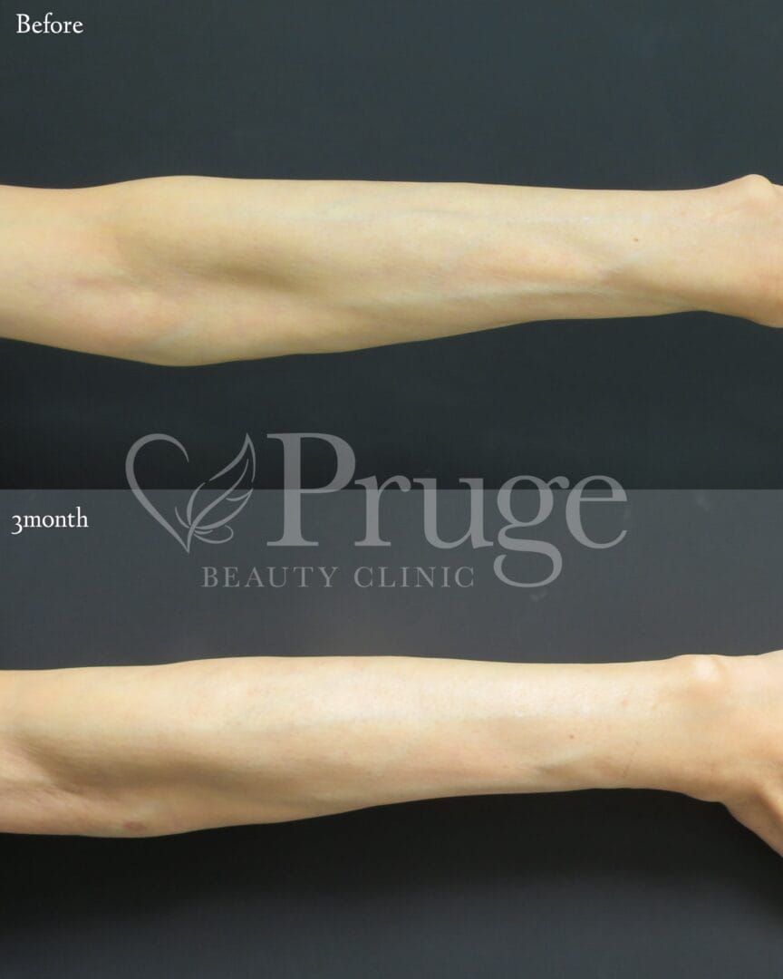 PRP注射(前腕)の症例写真