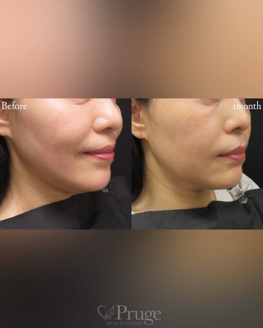 pスリム注射(フェイスライン)の症例写真