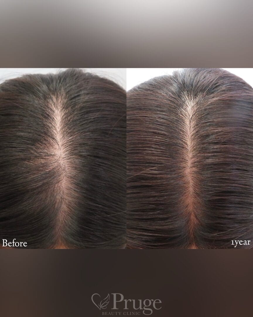 p-Scalpの症例写真