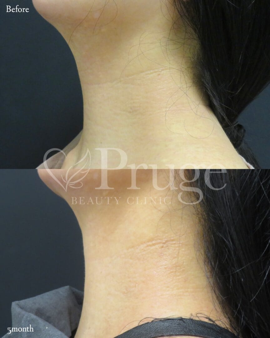 PRP注射(首)の症例写真