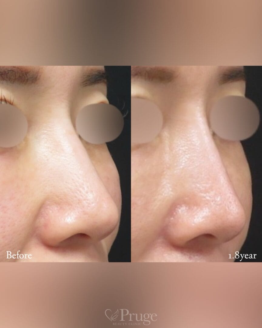 PRP注射（鼻根・鼻尖）の症例写真