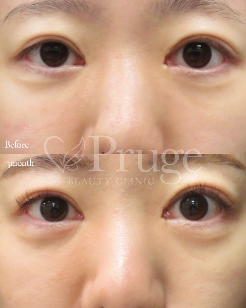 PRP注射(涙袋)の症例写真