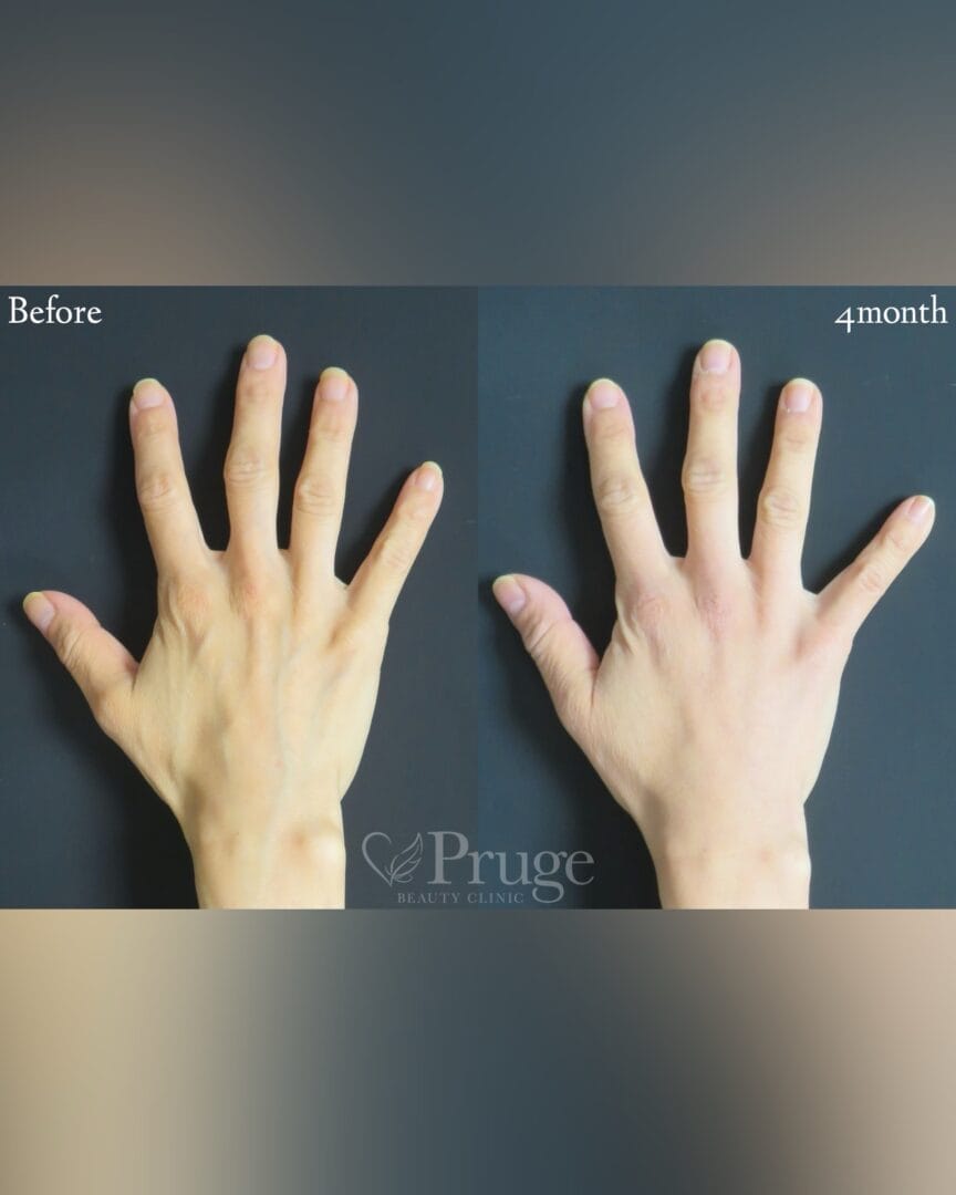 PRP注射(手の甲・指)の症例写真