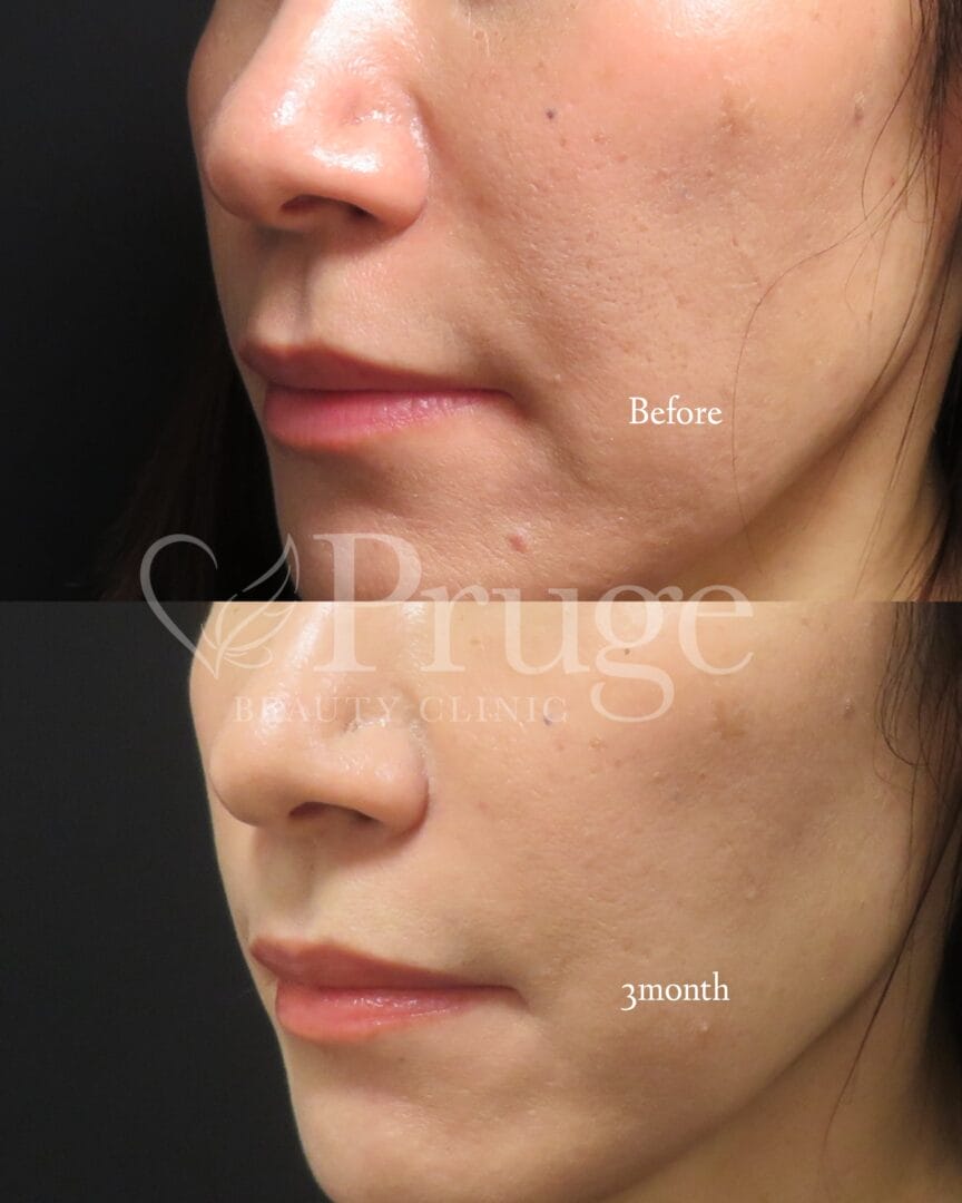 PRP注射(ほうれい線)の症例写真