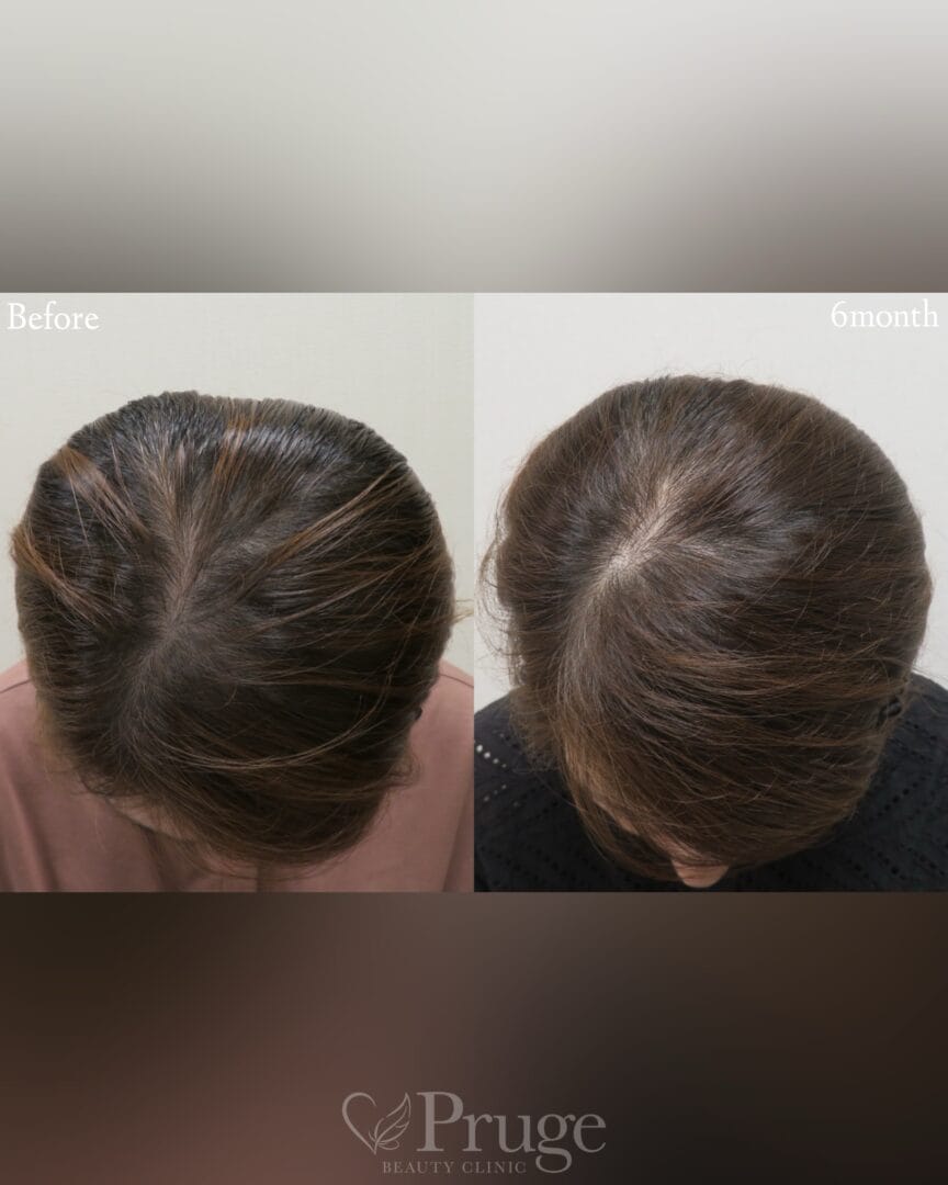 PRP注射(後頭部形成術)の症例写真