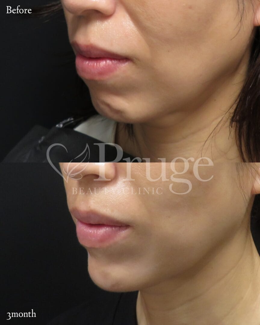 PRP注射（あご）の症例写真