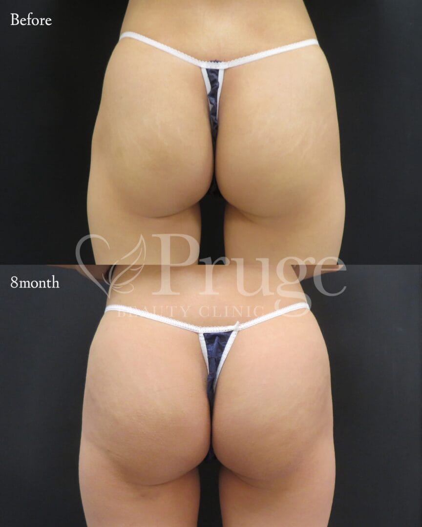 PRP注射によるヒップ形成の症例写真