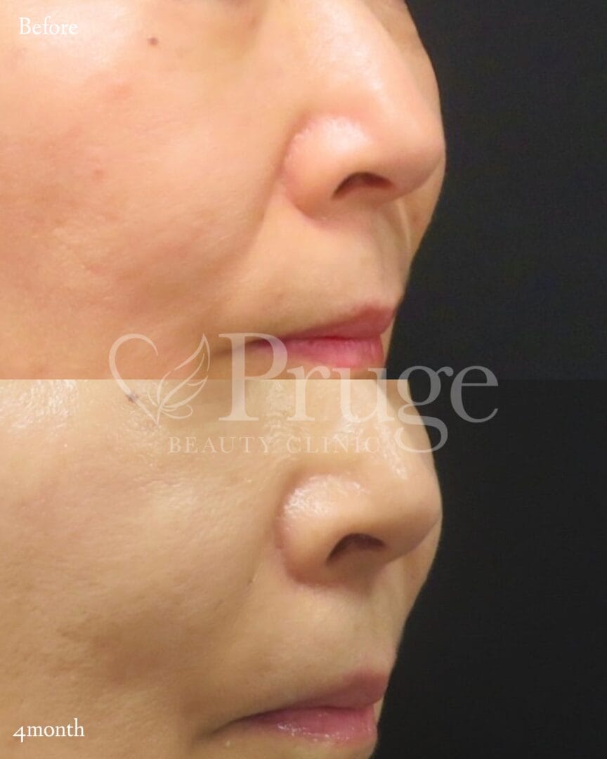 PRP注射(ほうれい線)の症例写真