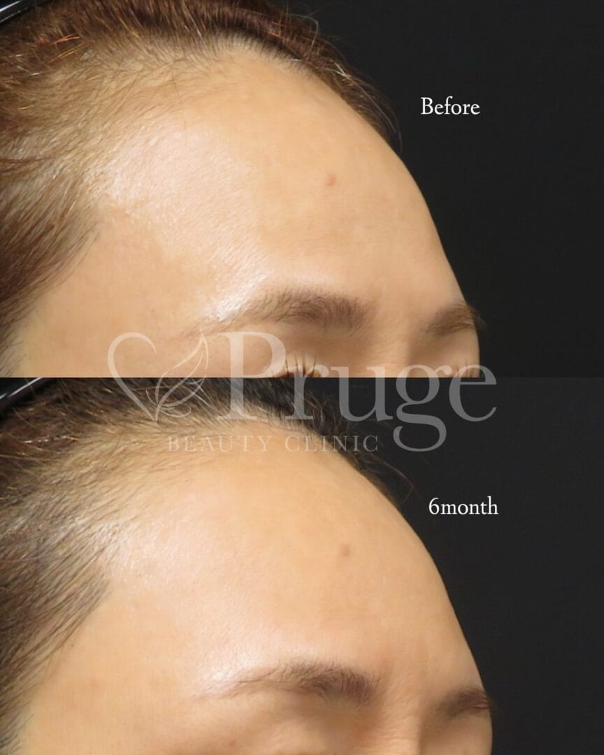PRP注射(額のシワ)の症例写真