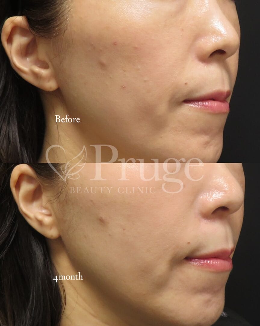 PRP注射(ホホ)の症例写真